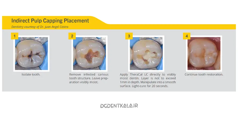 Bisco Theracal lc Indirect Pulp Capping