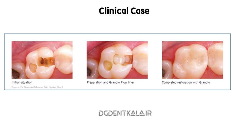 VOCO Grandio Posterior clinical case