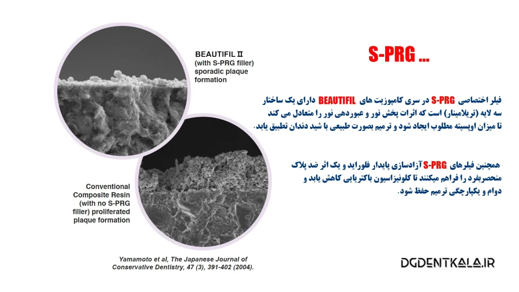 فیلر S-PRG و مزیت های آن