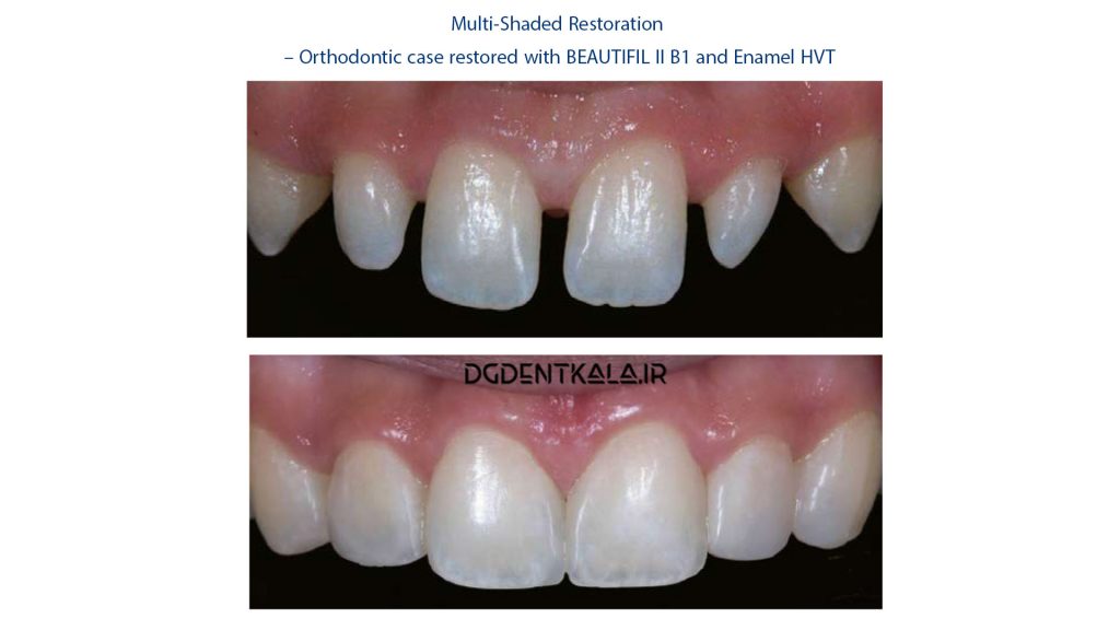 Clinical Case : Shofu Beautifill Multi-Shaded Restoration
