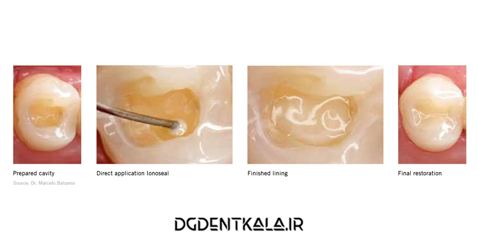 VOCO Ionoseal Clinical Case
