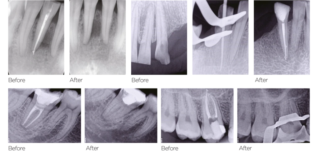 Ceraseal clinical case
