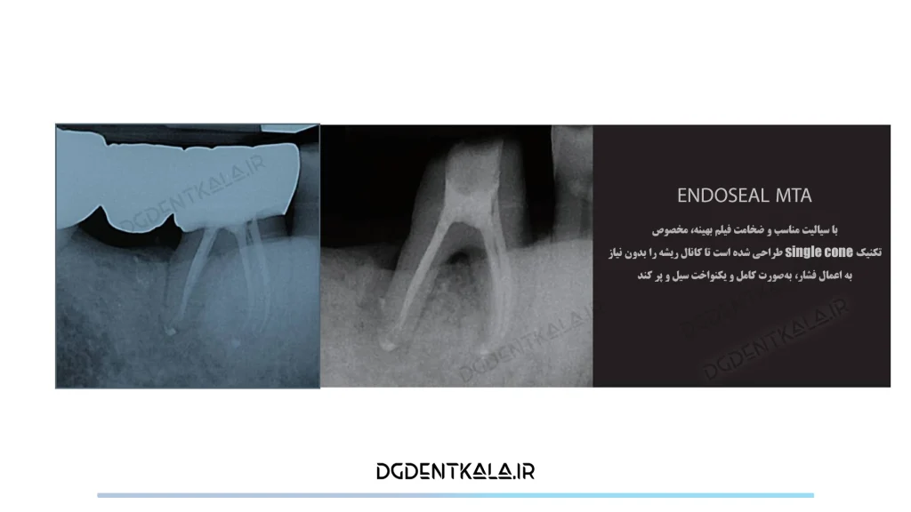 Maruchi Endoseal MTA single cone tech
